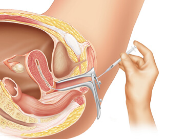 IUI